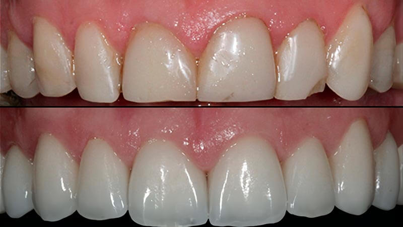 Результаты после реставрации зубов