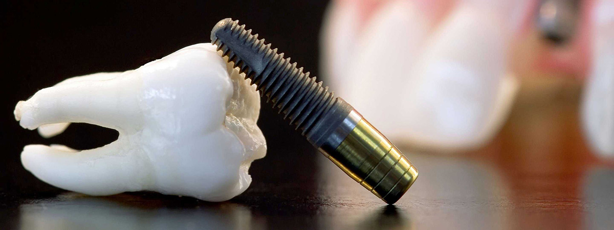 Имплантация зубов при остеопорозе