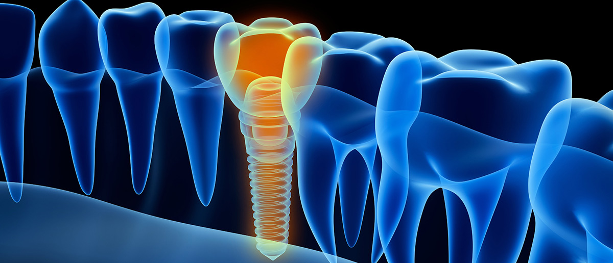 Имплантация зубов 3D