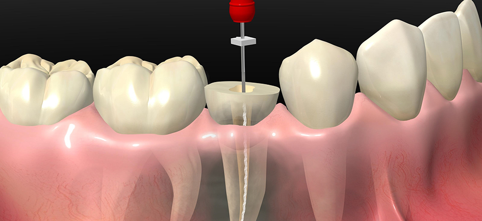 Депульпация зуба перед протезированием